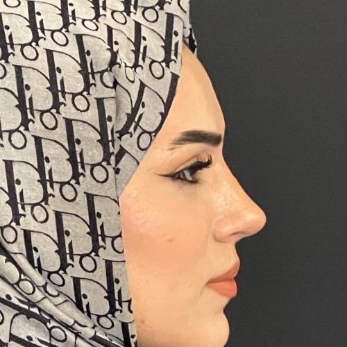 Ультразвуковая ринопластика Фотографии до и после